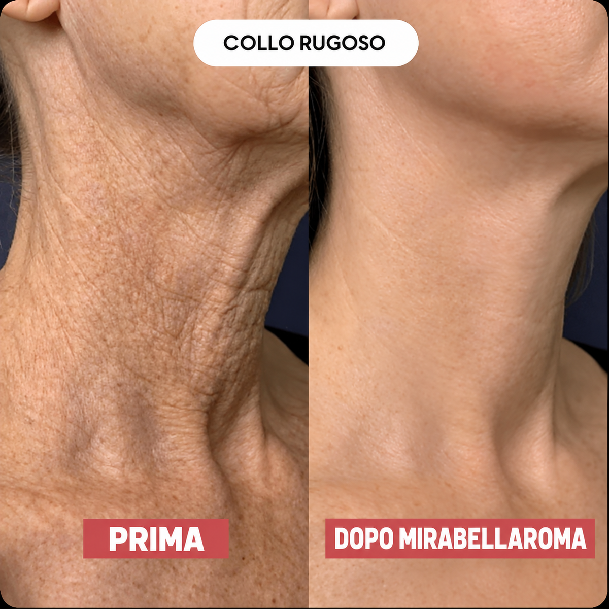 Mirabellaroma™ Lift – Torna ad amare il tuo collo